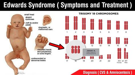 Edwards syndrome | types of Edwards syndrome | symptoms, treatment ...