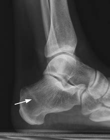 Calcaneal Stress Fracture - Posterior Foot Pain