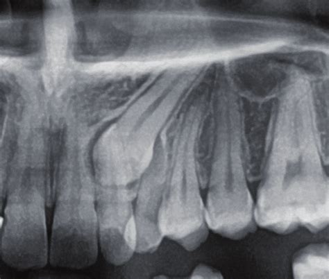 Radiograph of dentigerous cyst in maxillary impacted canine. | Download Scientific Diagram