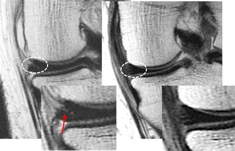 A Knee Meniscus Stem Cell procedure to repair a torn meniscus.