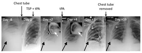 Cureus | Intrapleural Fibrinolytic Therapy Improves Results With Talc ...