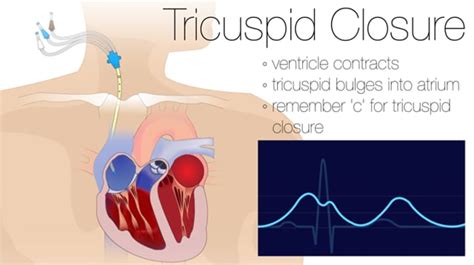 Understanding CVP Waveforms