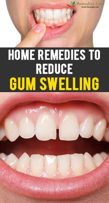 Home Remedies to Reduce Gum Swelling - Remedies Lore