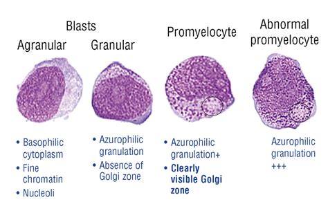 Diagnosis and classification of myelodysplastic syndrome: International ...