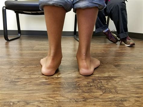 Flexible Pes Planovalgus (Flexible Flatfoot) - Pediatrics - Orthobullets