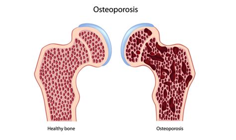 New Treatment Options for Brittle Bone Disease