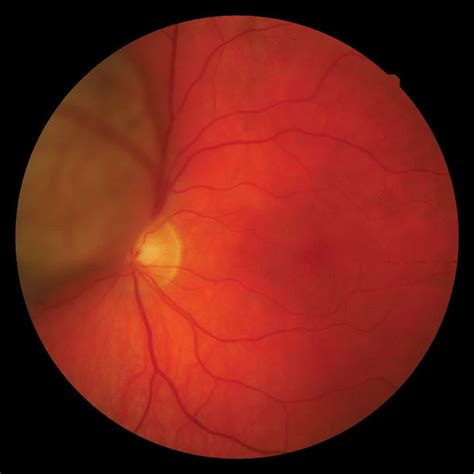 Clinical photography - Choroidal melanoma | Spectrum