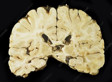 Brain in multiple sclerosis - Stock Image - C023/5577 - Science Photo ...