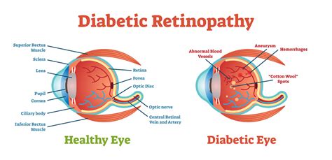 Diabetic Eye Disease (PDR)- Laser Surgery | Eye Patient