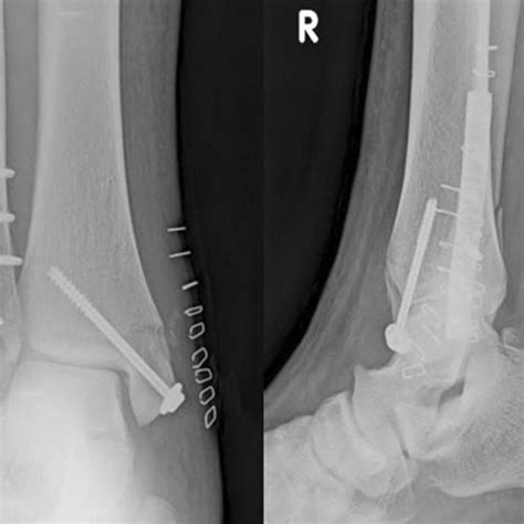 Sixteen weeks postoperative X-ray of closed reduction internal fixation... | Download Scientific ...