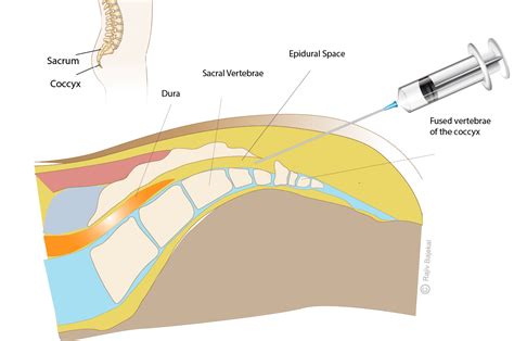 Caudal Epidural Injections – Rajiv Bajekal