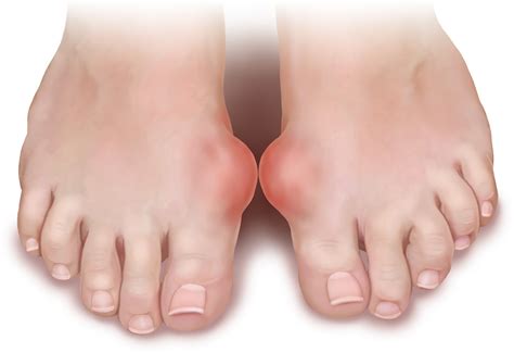 Gout Arthritis: 4 Phase Development Of Gout Arthritis | Singapore ...