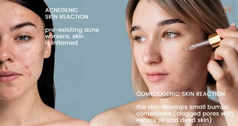 All you need to know about comedogenic ingredients | Native Essentials ...