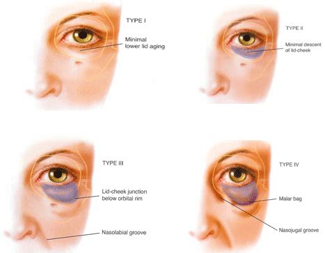 Tear Trough — Elanamie Clinic