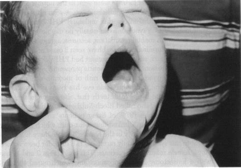 Hypoplastic teeth in same child as in Fig 3 with incontinentia pigmenti ...