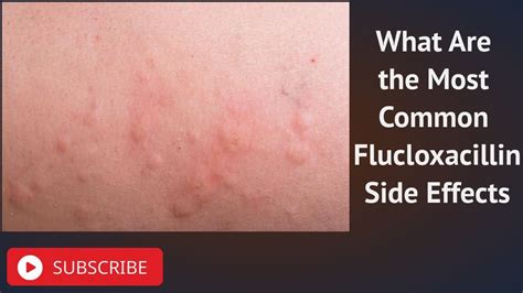 What Are the Most Common Flucloxacillin Side Effects - YouTube