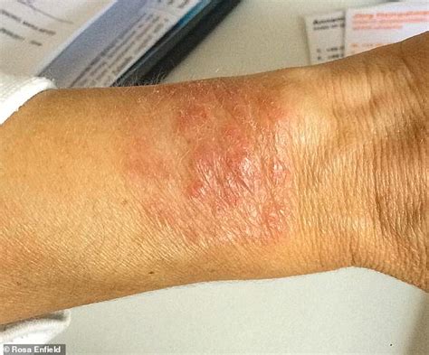 Woman finds miracle cure for excruciating eczema with donkey milk salve | Daily Mail Online