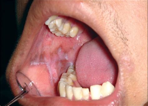 Clinical photograph showing reticular lichen planus of right buccal... | Download Scientific Diagram