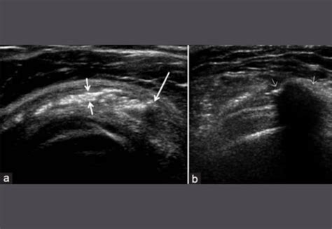 Calcific bursitis - Allied Health Professionals