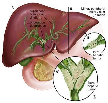 Cholangiocarcinoma - RPS Hospitals