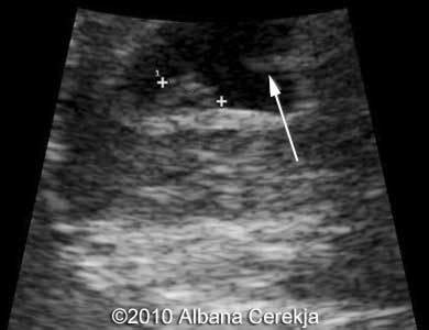 📃 Uterine synechiae