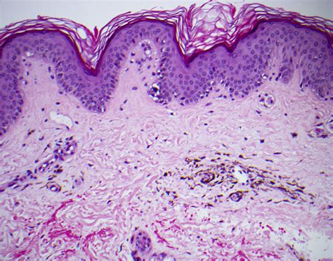 Agminated Blue Nevus Arising in a Nevus Spilus | Consultant360