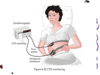 Cardiotocography | PPT