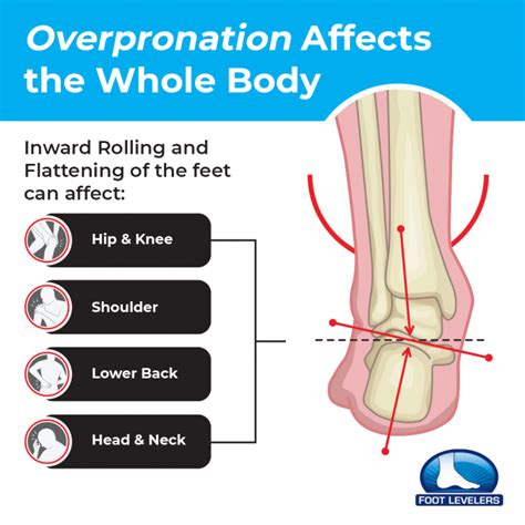 Foot Levelers