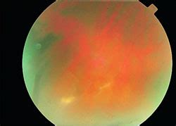 vitritis - Uveitis.org | OIUF