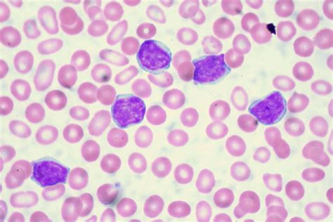 Leukemia | Definition, Causes, Symptoms, & Treatment | Britannica