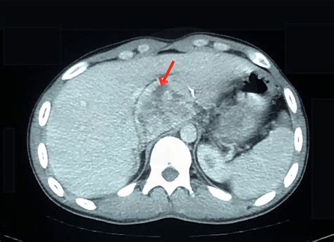 Pheochromocytoma Ct Scan