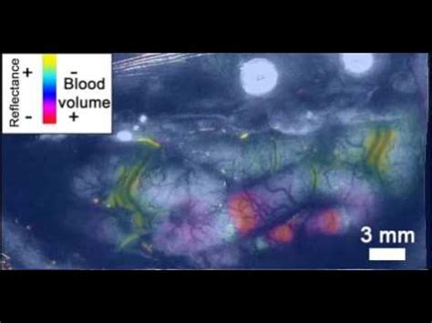 Scintillating scotoma causes with and without migraine headaches - Migraine Professional