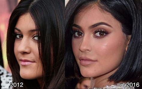 Kylie Jenner Before and After ? All of her Plastic Surgery!