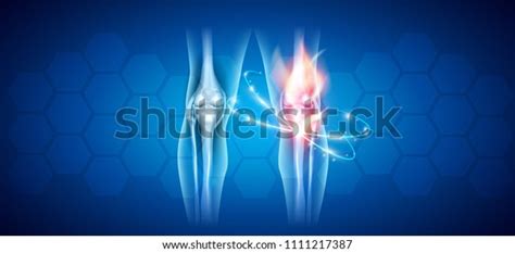 5,354 Knee Infection Images, Stock Photos & Vectors | Shutterstock