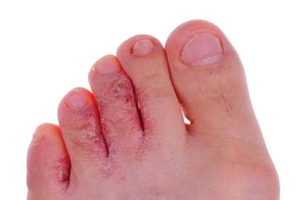 Tinea Pedis (Athlete's Foot) – Pictures, Symptoms, Infection and Treatment