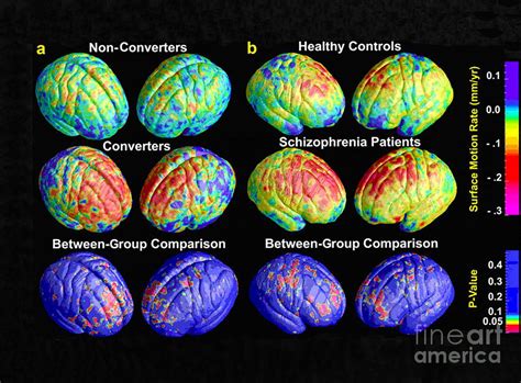 Schizophrenia, 3d Mri Scans Photograph by Science Source