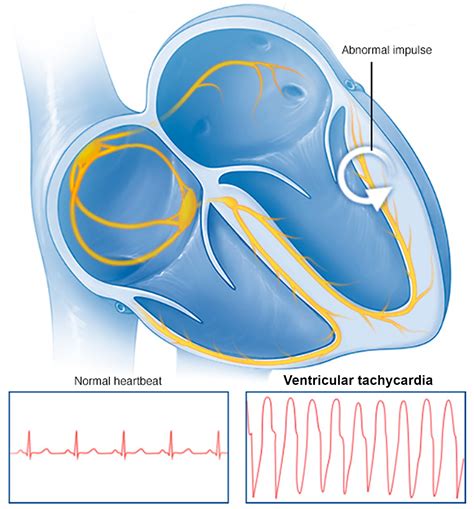 Tachycardia - Causes, Signs, Symptoms, Types, Diagnosis & Treatment