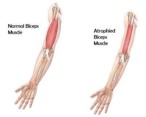 Are you Suffering from Muscle Atrophy? - HubPages