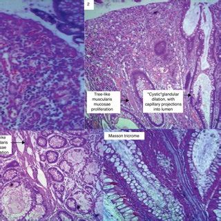 Histological study: biopsy of polyp with hyperplastic aspect (1).... | Download Scientific Diagram