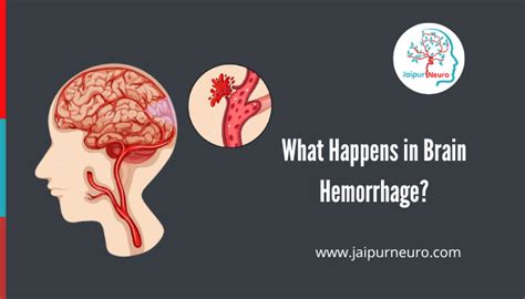 What Happens in Brain Hemorrhage? | JaipurNeuro