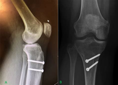 Tibial Tubercle Osteotomy Continues to Evolve | AOSSM