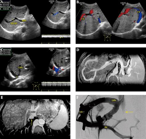 Ultrasonic Evaluation of Spontaneous Portosystemic Shunts in Patients ...