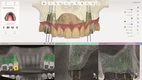 CAD Software - Dental Axess