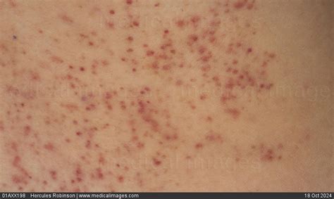 STOCK IMAGE, dermatology petechia from vomiting a fine red vesicular rash on a child with ...