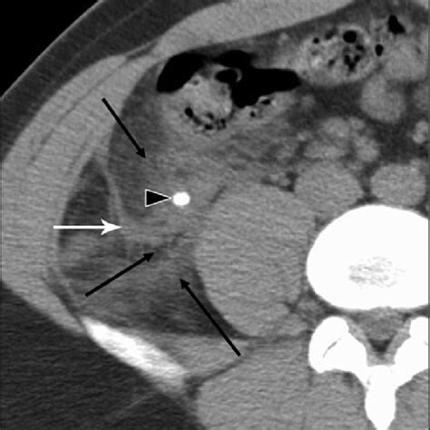 Acute Appendicitis On Ct Scan