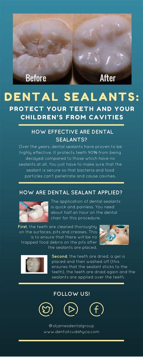 Dental sealants are protective covering of the teeth to keep it from ...