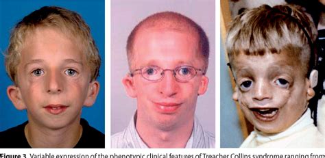 Figure 3 from Clinical Implications of Treacher Collins Syndrome | Semantic Scholar