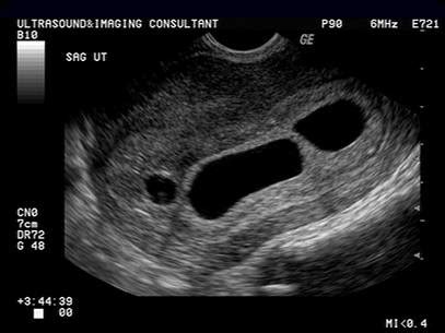 Vanishing Twin Syndrome Ultrasound