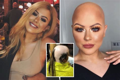 🙌 Make-up artist who was diagnosed with alopecia at 16 and tried to cover her bald spots with ...