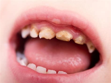 Tooth decay in children costing the NHS more than £40m a year, figures show | The Independent ...